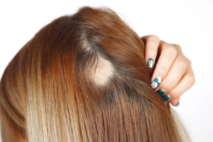 What is Alopecia?