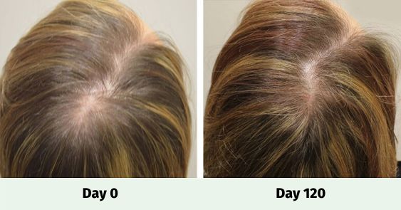 Side by Side image of a woman before using Evolis Products and after 120 days of use