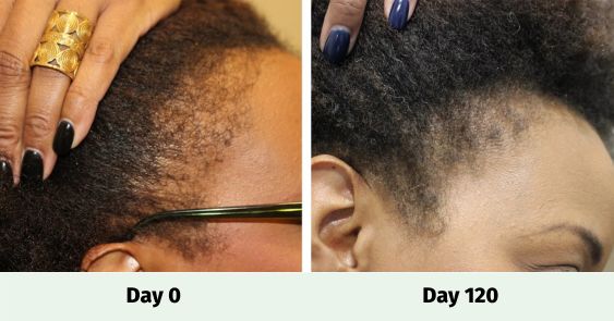 Side by Side image of a woman's hairline before and after using Evolis Products